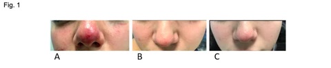 studia 1 nos rosacea_1