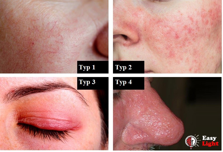 rosacea-types