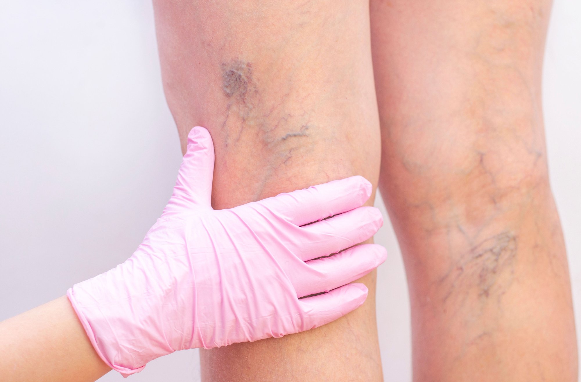 Čo na kŕčové žily? Zistite, aké máte možnosti pri liečbe a prevencii