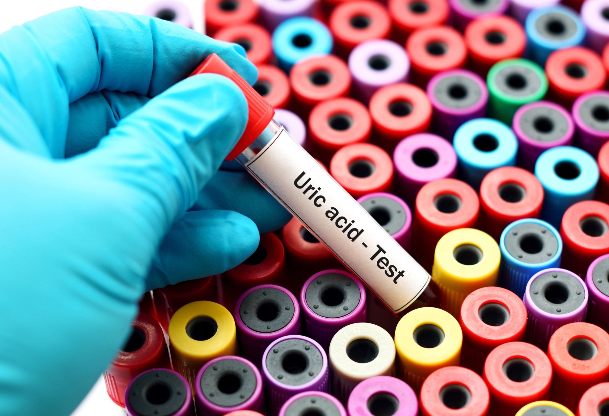 Čo znamená zvýšená kyselina močová v krvi a ako ju dostať pod kontrolu?