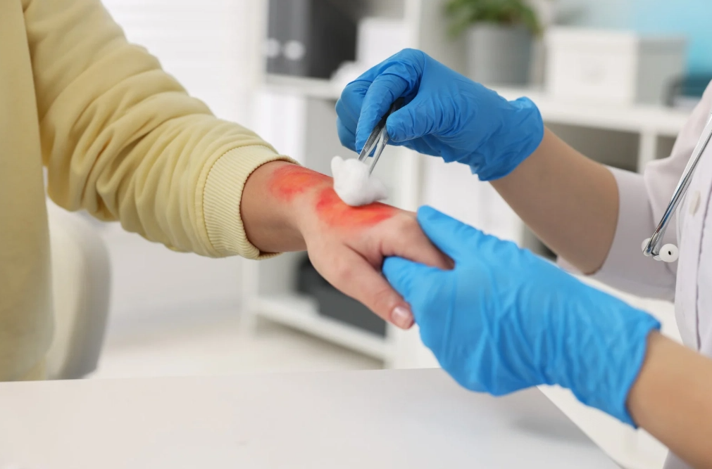 Čo pomáha na popáleniny: Účinné tipy, babské rady a doplnky pre rýchle hojenie