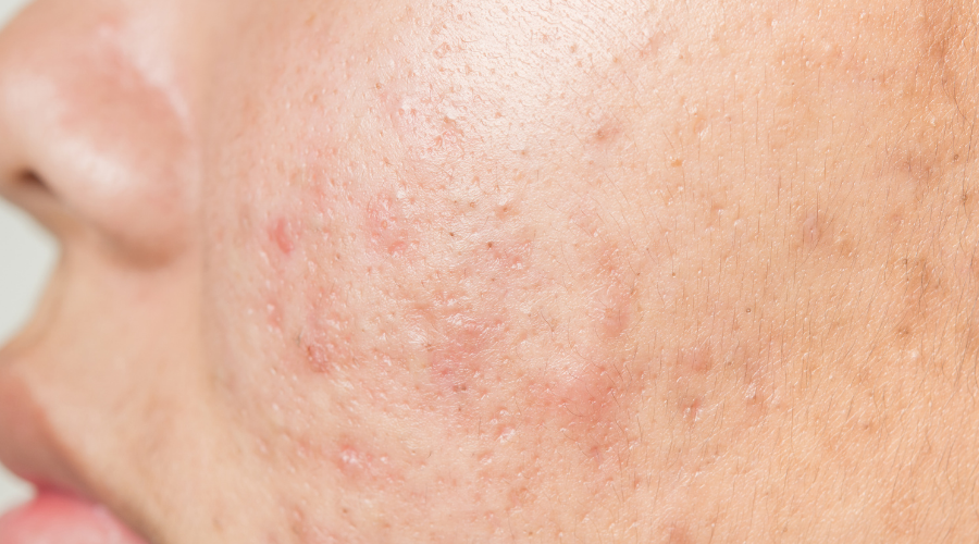 Mastná pleť a akné: Skutečný příběh, který mi změnil život