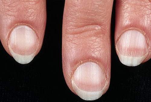 If you don't have the white part on your nail, is that a bad thing? Plus  what does it mean if you don't have the white part on your nail? - Quora