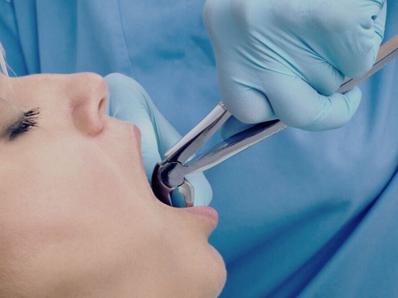 Jak pečovat o svou ústní pohodu po extrakci zubu: Pojistěte si bezproblémové hojení