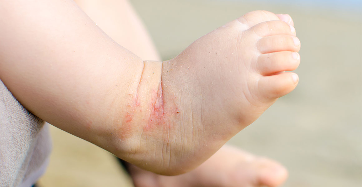 Dermatitida u kojenců