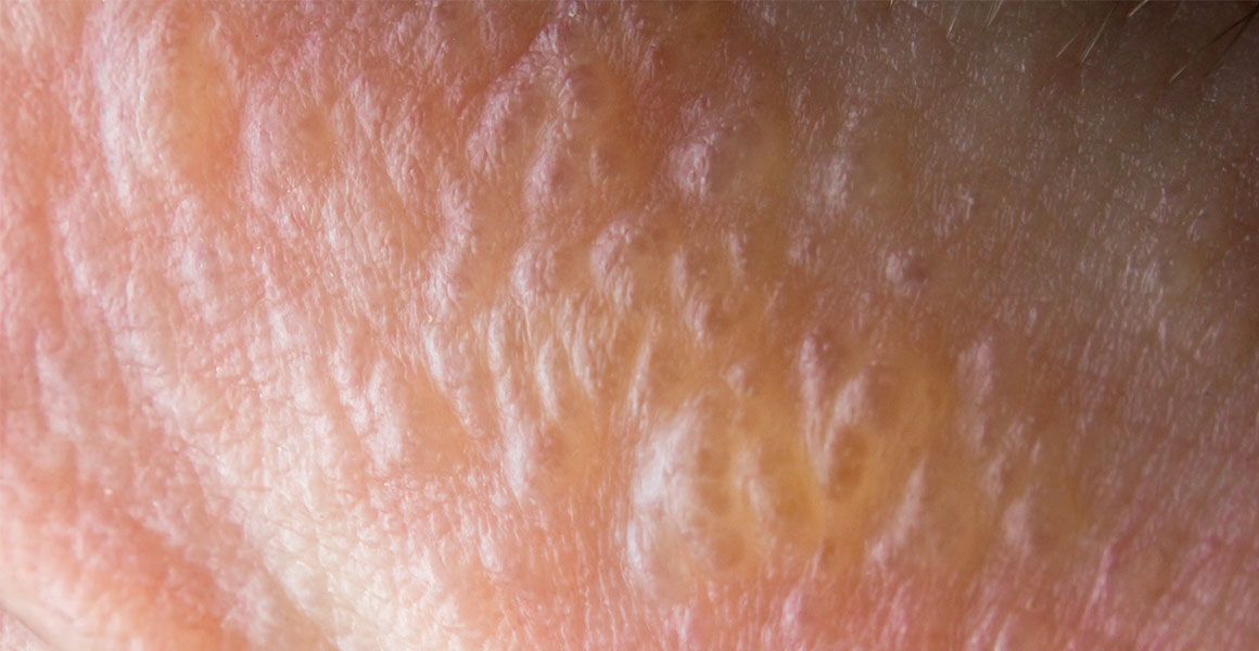 Dyshidrotická dermatitida