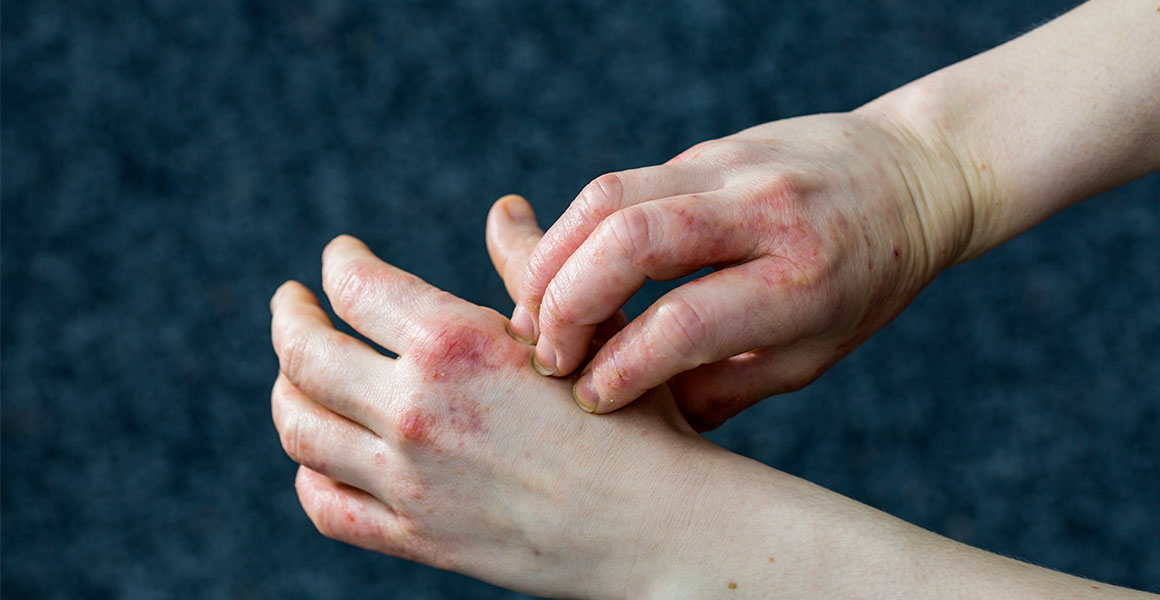 Water Blisters and Vesicles on Hands and Feet: A Complete Guide to Dyshidrotic Eczema