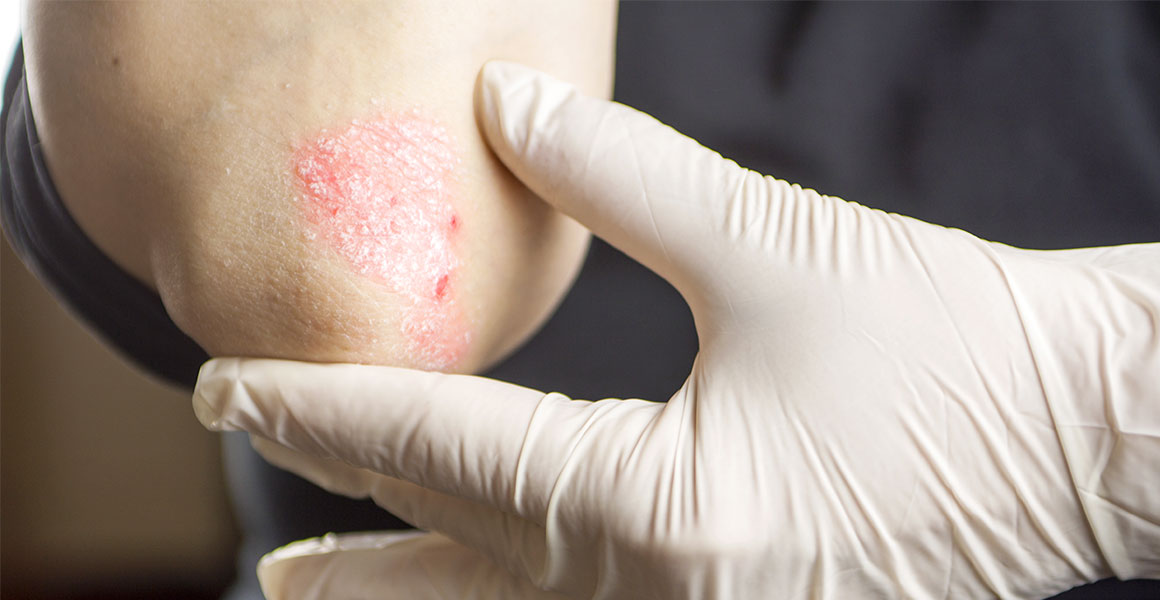 Atopická dermatitida