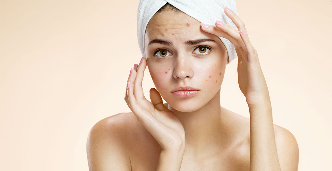 Jak se zbavit akné na obličeji