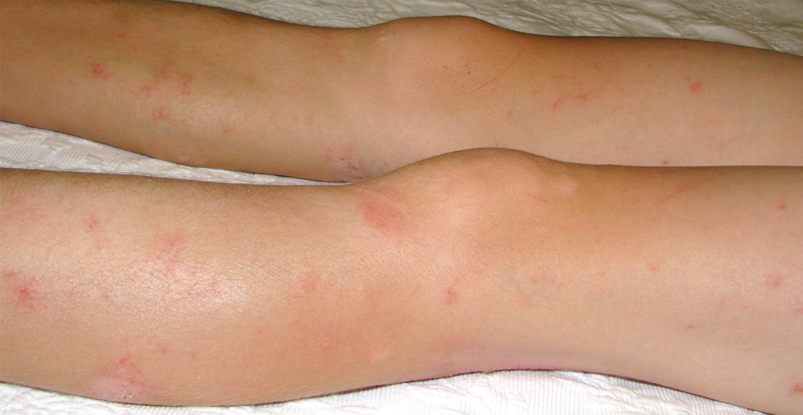 Ekzém na nohou