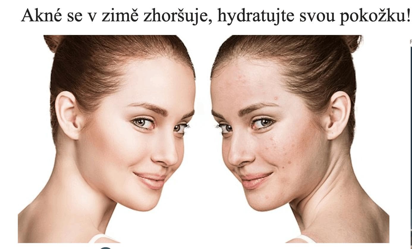 AKNE WIRD IM WINTER SCHLIMMER, VERSORGEN SIE IHRE HAUT MIT FEUCHTIGKEIT!
