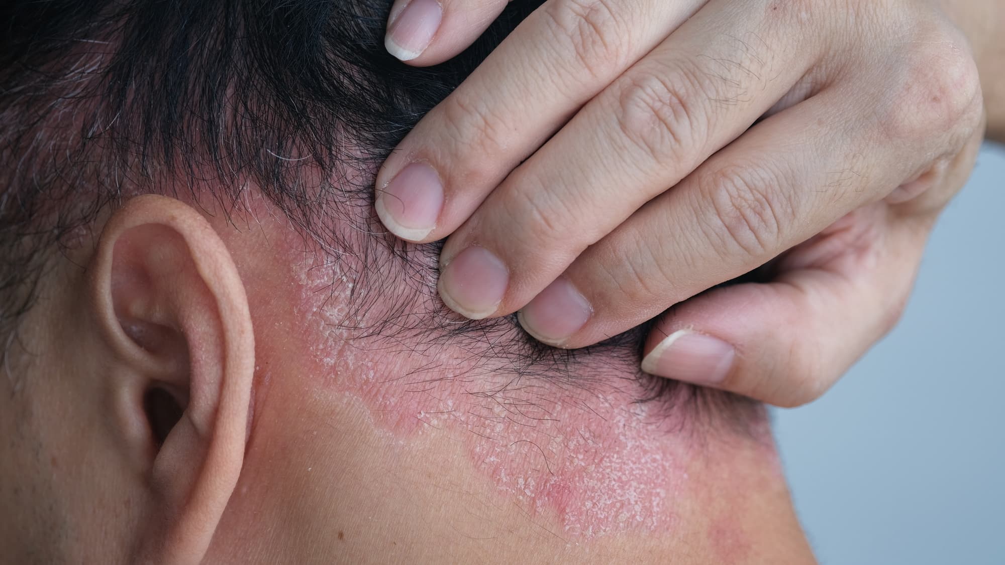 Schuppenflechte auf der Kopfhaut? Bioaktives Shampoo als Lösung