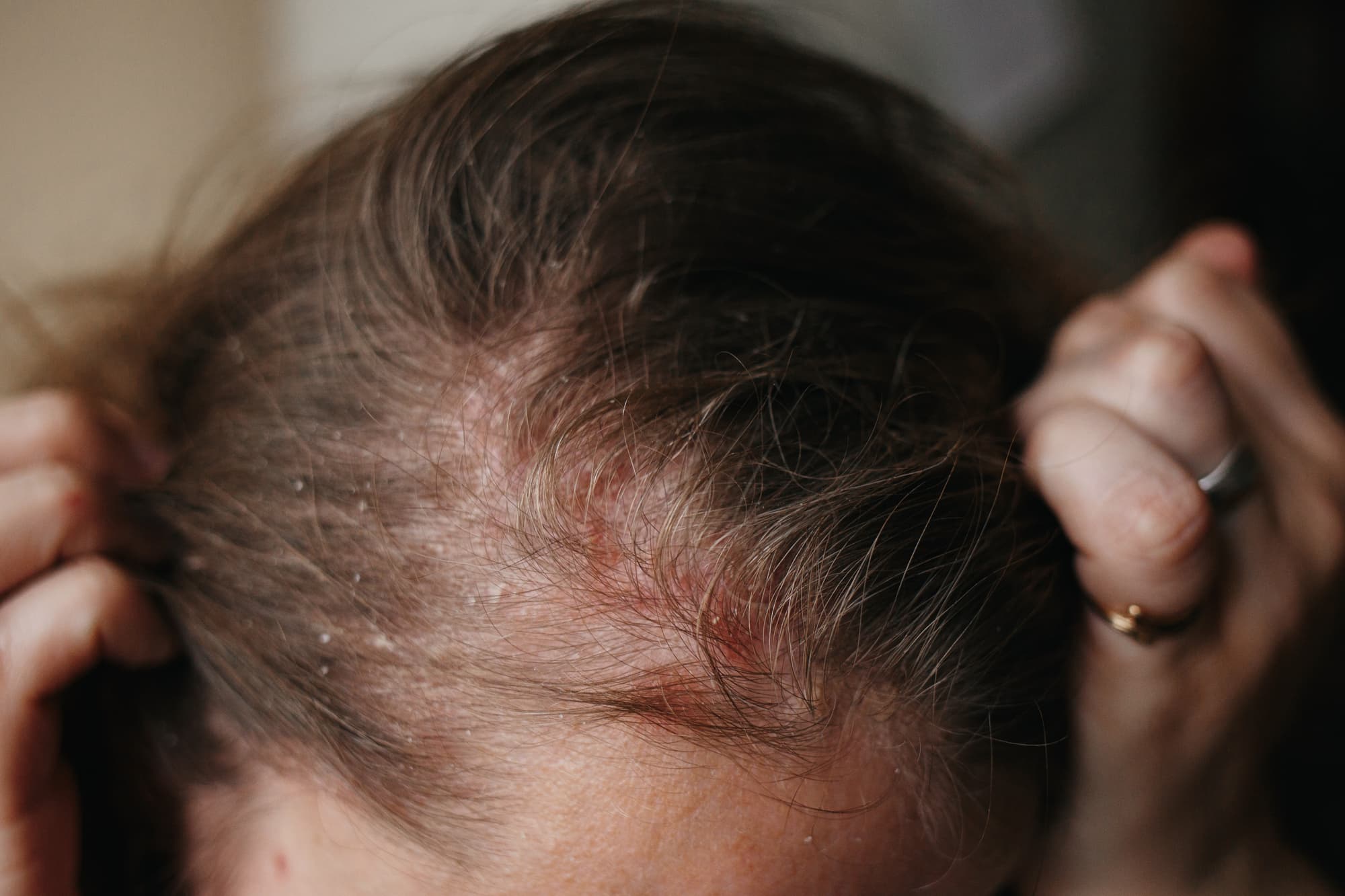 SCHUPPENFLECHTE IM HAAR: WIE ERKENNT MAN SIE UND WAS HILFT?