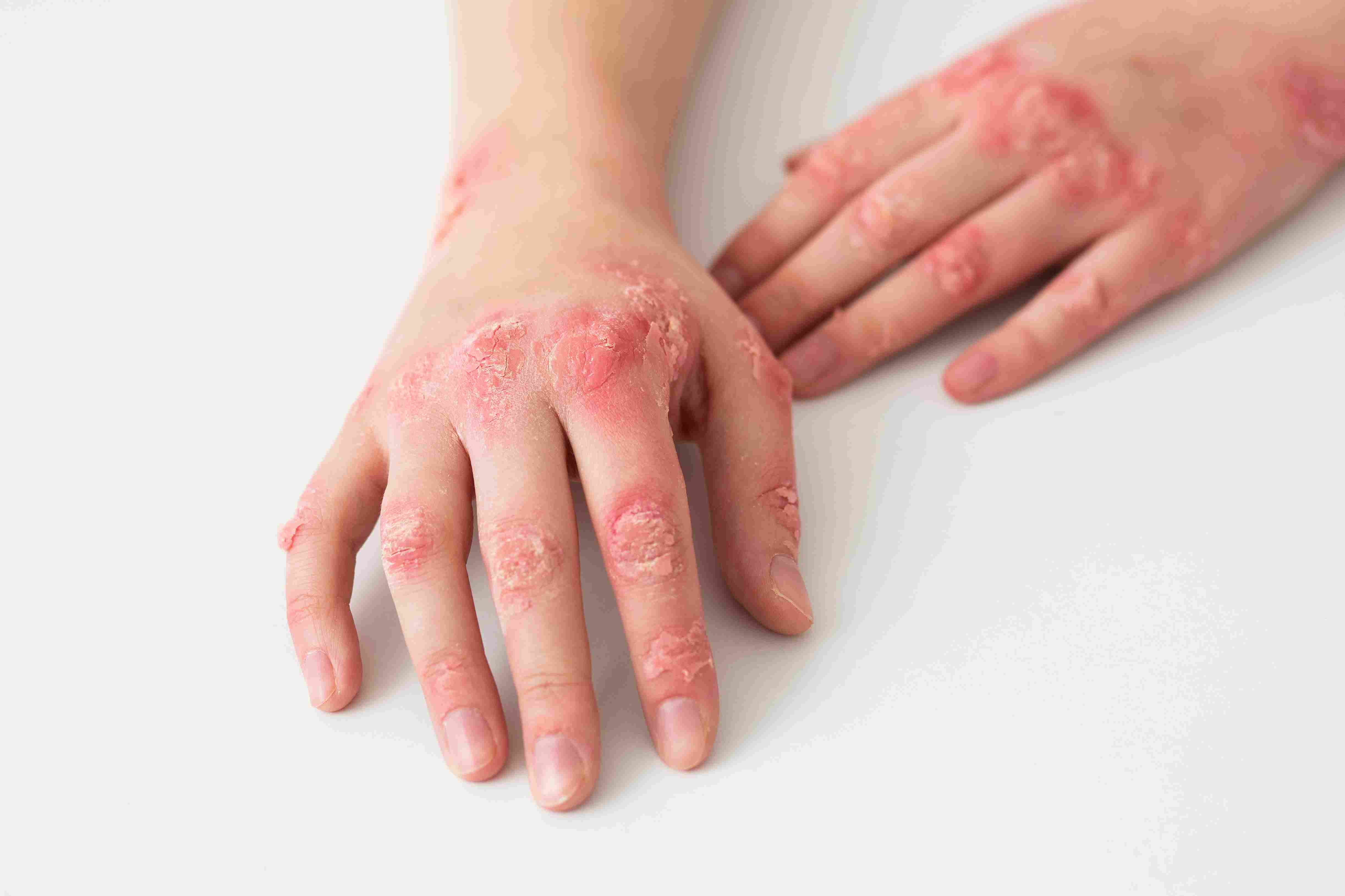 hands-patient-suffering-from-psoriasis_11zon