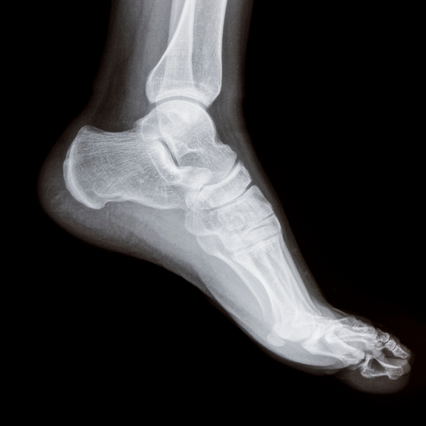 BĚŽECKÁ ZRANĚNÍ POHLEDEM EPIGENETIKY [článek]