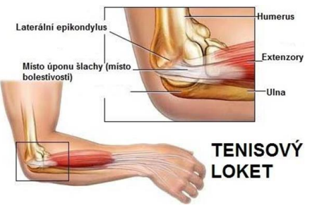 Tenisový loket