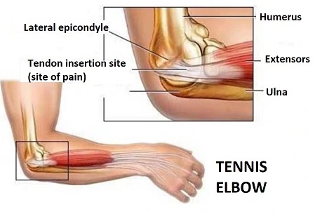 Tennis elbow