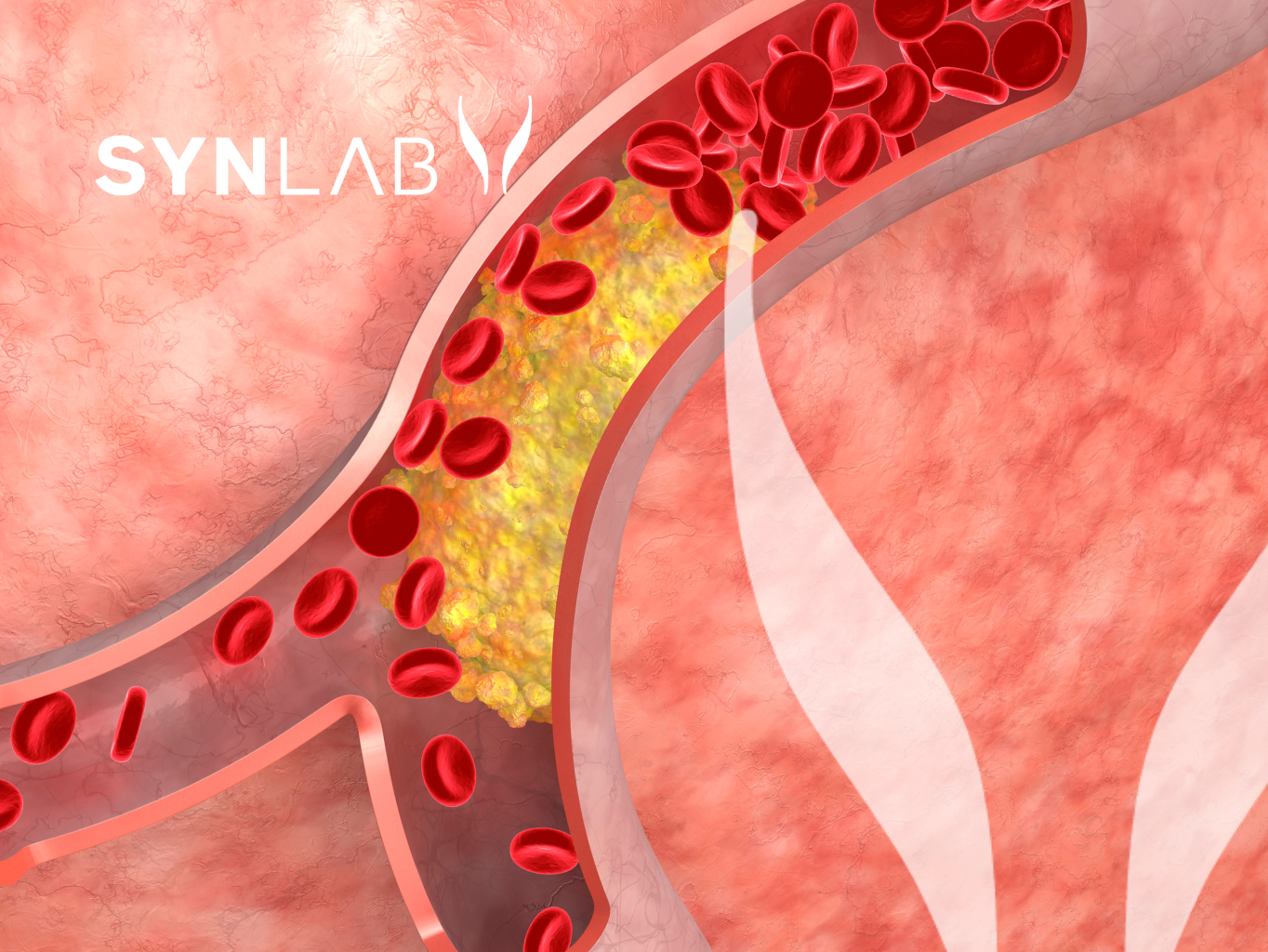 Vysoký cholesterol sa týka jednej tretiny Slovákov. Udržať si jeho zdravú hladinu pritom nie je veda