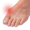 Hallux Valgus