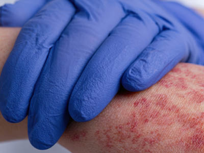 Alergie a jednorazové rukavice: Ako si vybrať tú pravú ochranu pre citlivú pokožku