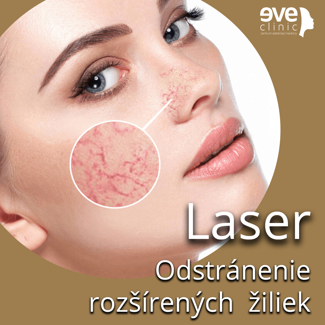 Laserové odstránenie žiliek - oblasť nos + líca