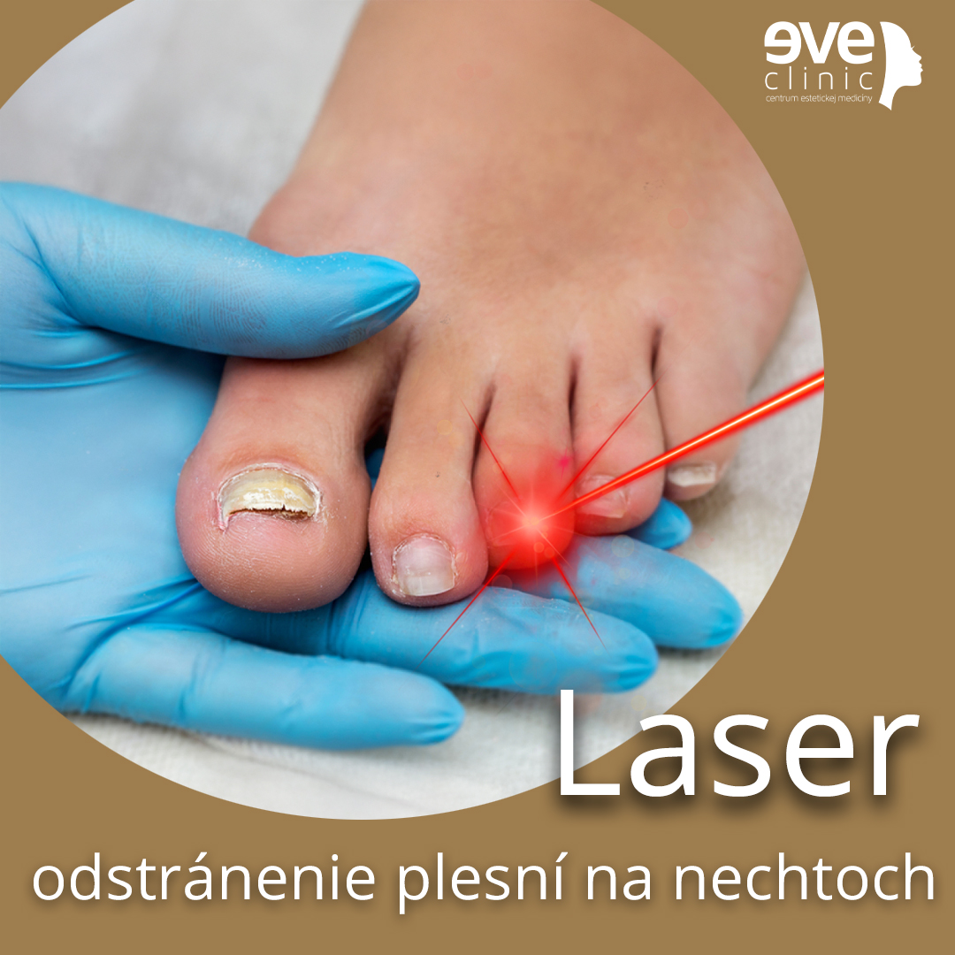Laserová liečba nechtovej plesni  Balíček  6 x ošetrenie  (onychomykóza)