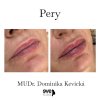Lippenvergrößerung mit Hyaluronsäure Juvederm ULTRA 3 - 1 ml