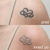 Laser-Tattoo-Entfernung 10x10cm schwarz