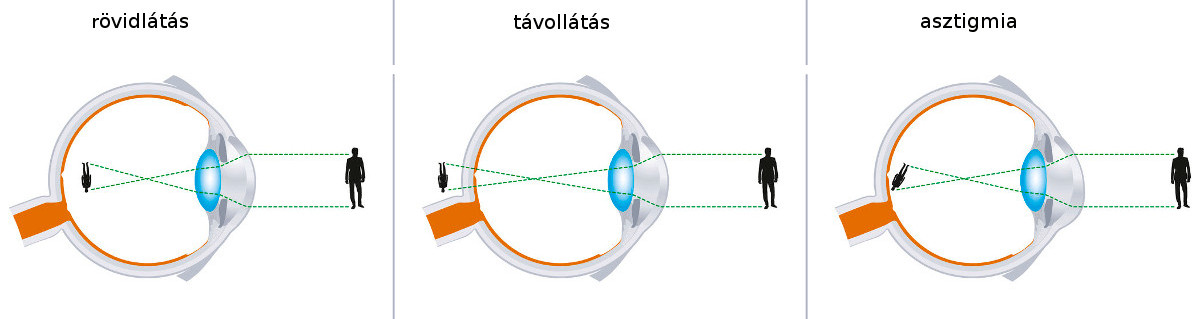 mi gyógyítja a látást