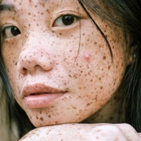 Jak rozeznat pigmentové skvrny a jak se jich zbavit