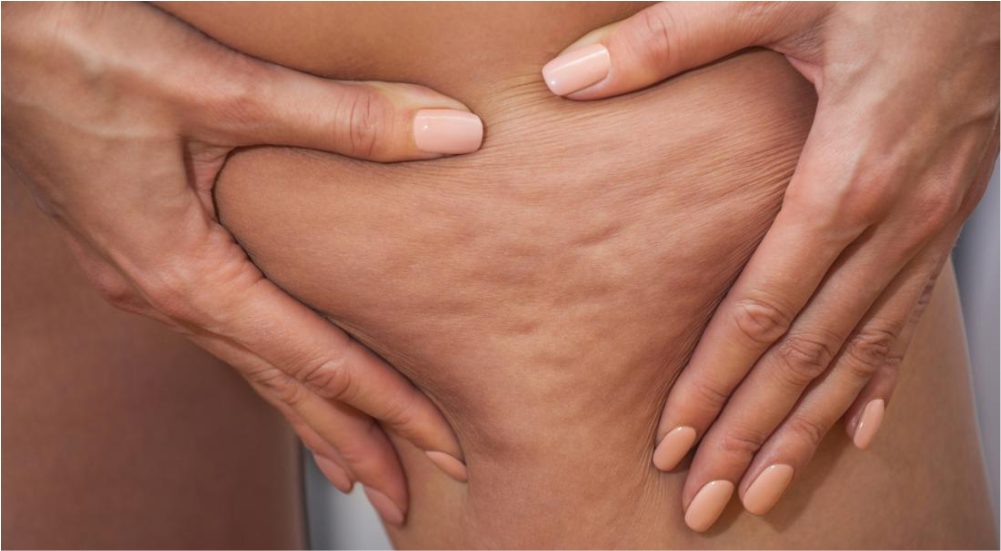 Jak se zbavit celulitidy? 5 účinných tipů, které opravdu fungují