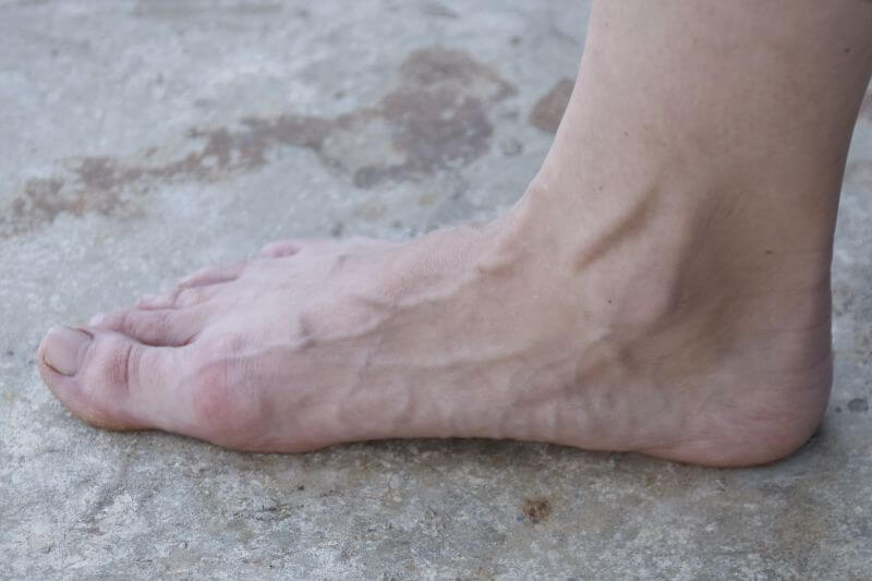 Hallux valgus = bunion