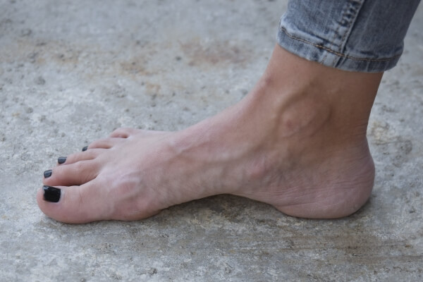 Foot arch - how to prevent a collapsed arch