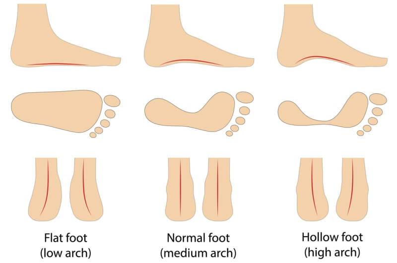 Arch types, low arch, medium arch, high arch