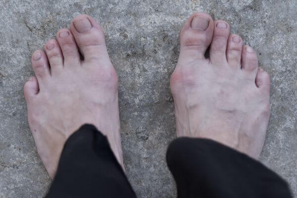 Hallux valgus = Ballenzeh