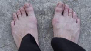 Hallux Valgus, verdrehte Zehen, deformierte Füße