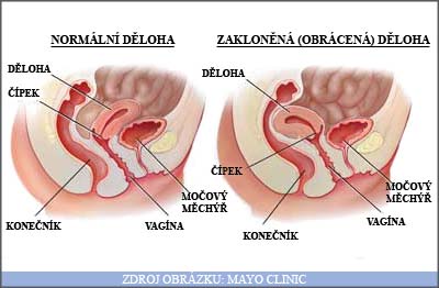 Co je to zakloněná (obrácená) děloha?