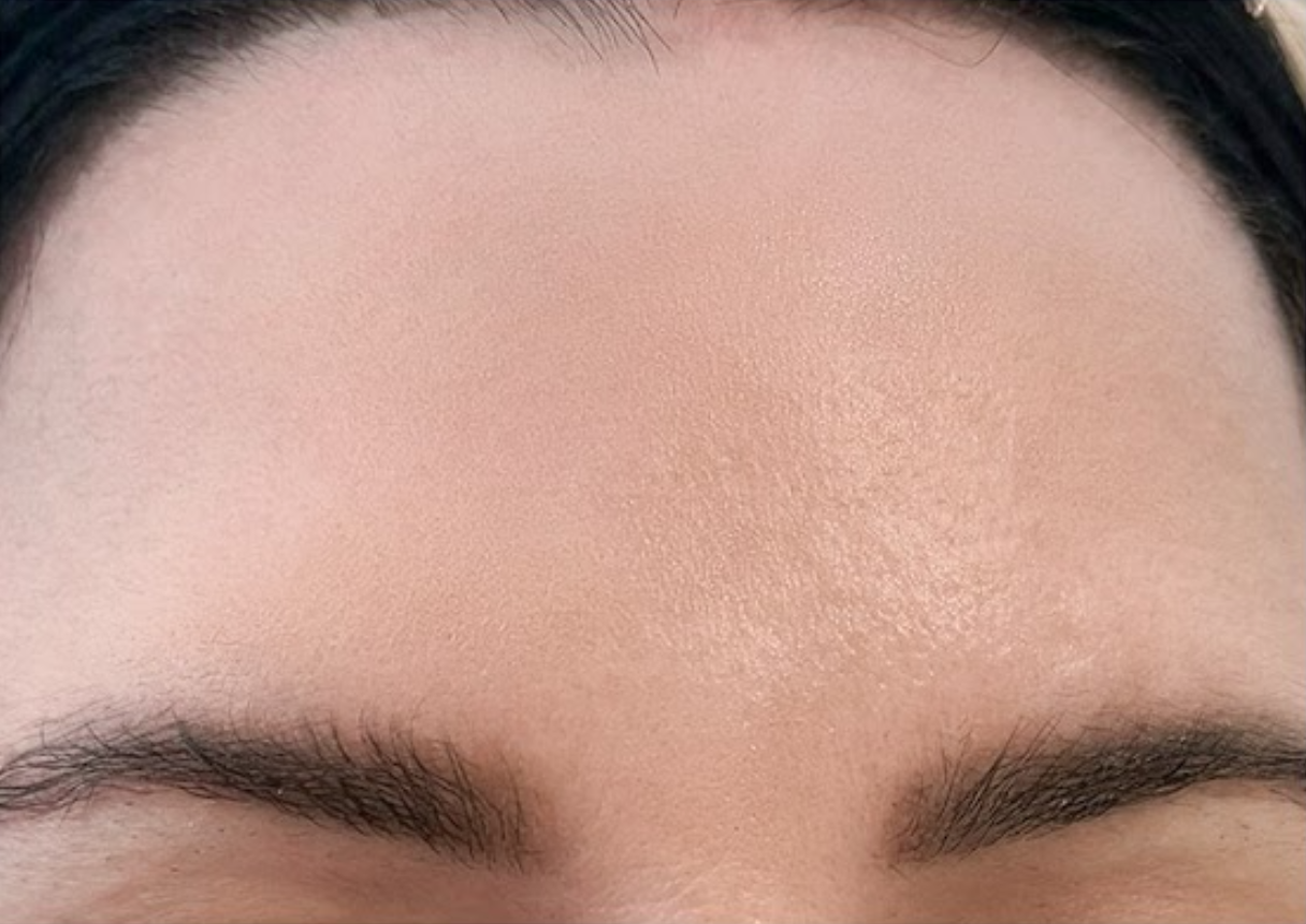 Po ošetření NAD Peel