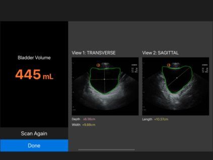 Bladder Volume Results 768x576