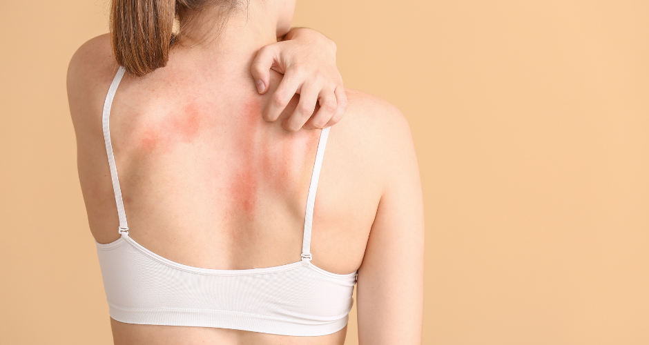 Jak léčit atopický ekzém: Tipy a přírodní metody