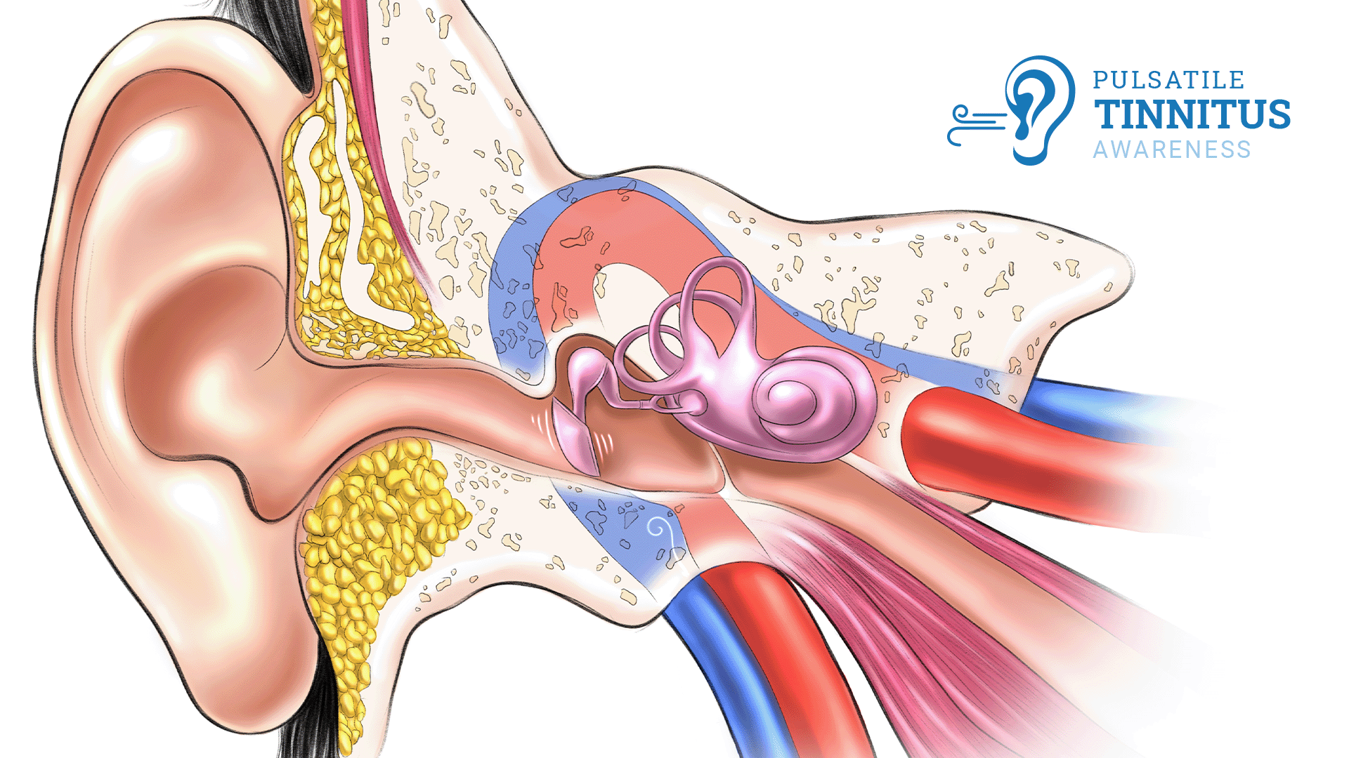 neurosurgeronsofnewjersey-pulsatile-tinnus-cases