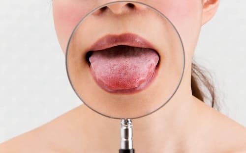 Aphten im Mund Ursachen und Behandlung