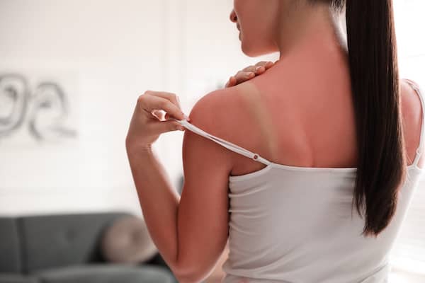 Beste Salbe gegen Brandwunden und Verbrennungen