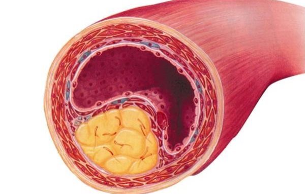 CBD Öl gegen Arteriosklerose