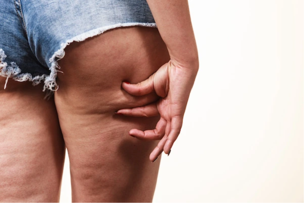 Wie hilft Hanf gegen Cellulite und Dehnungsstreifen?