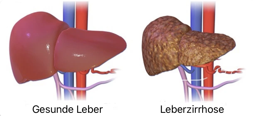 Leberzirrhose