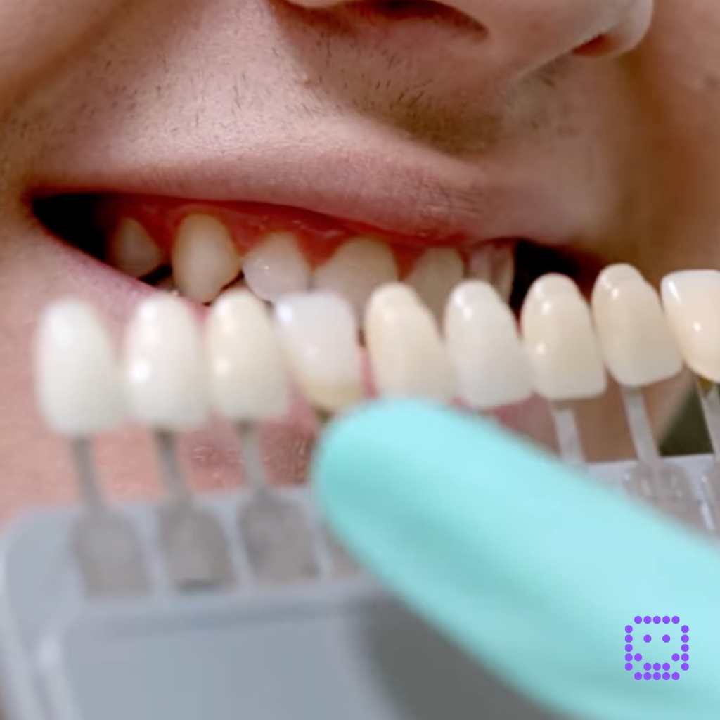 Domácí vs. ambulantní bělení zubů: jaký je mezi nimi rozdíl?