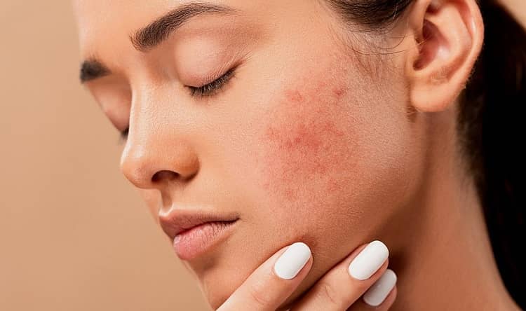 Jak se rychle zbavit akné? Dejte šanci CBD