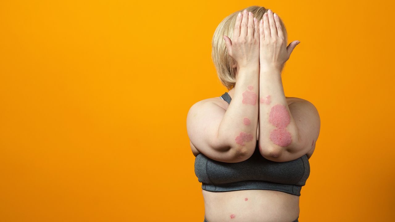Víte, jaké jsou příznaky psoriázy (lupénky), jak ji léčit a jaká je prevence? Ověřené doktorem.