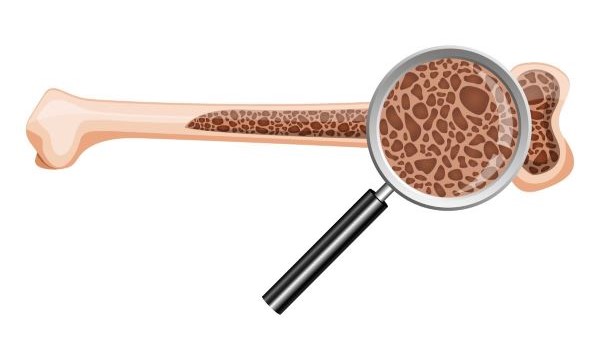 Jak udržet kosti silné a zdravé: Kompletní průvodce pro prevenci osteoporózy